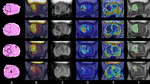 AI-Driven Radiomics for Precision Prostate Cancer Therapy